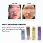 Before and after images of a teenage's face showing progressive improvement of acne-prone skin using LUWIN skincare products, alongside product boxes and labelled stages of transformation.