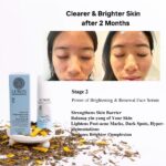 Before and after images of a teenage girl’s face showing significant improvement in acne and brighter skin after using LUWIN Power of Brightening & Renewal Face Serum for two months, accompanied by product packaging and dried herbal ingredients.