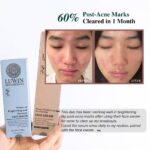 60% post-acne marks cleared using LUWIN Powerful Brightening & Rejuvenating Duo