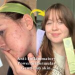 Young woman showing before and after results using LUWIN Ultimate Repair & Clear Face Cream for acne-prone skin and All-Rounder Calming & Radiance-Enhancing Facial Mist, with visibly reduced breakouts and clearer, healthier skin.