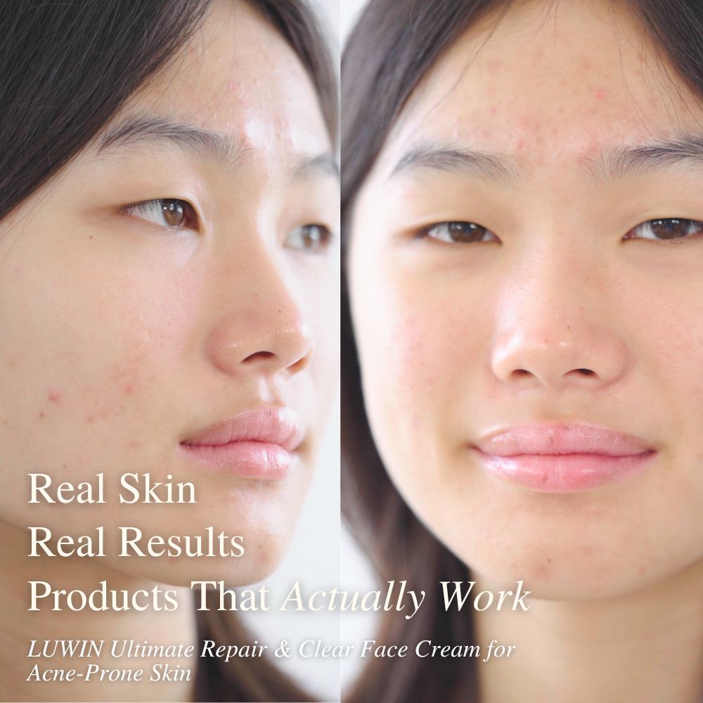 User 3B LUWIN Ultimate Repair & Clear face cream for acne shows real results on real skin highlights its effectiveness