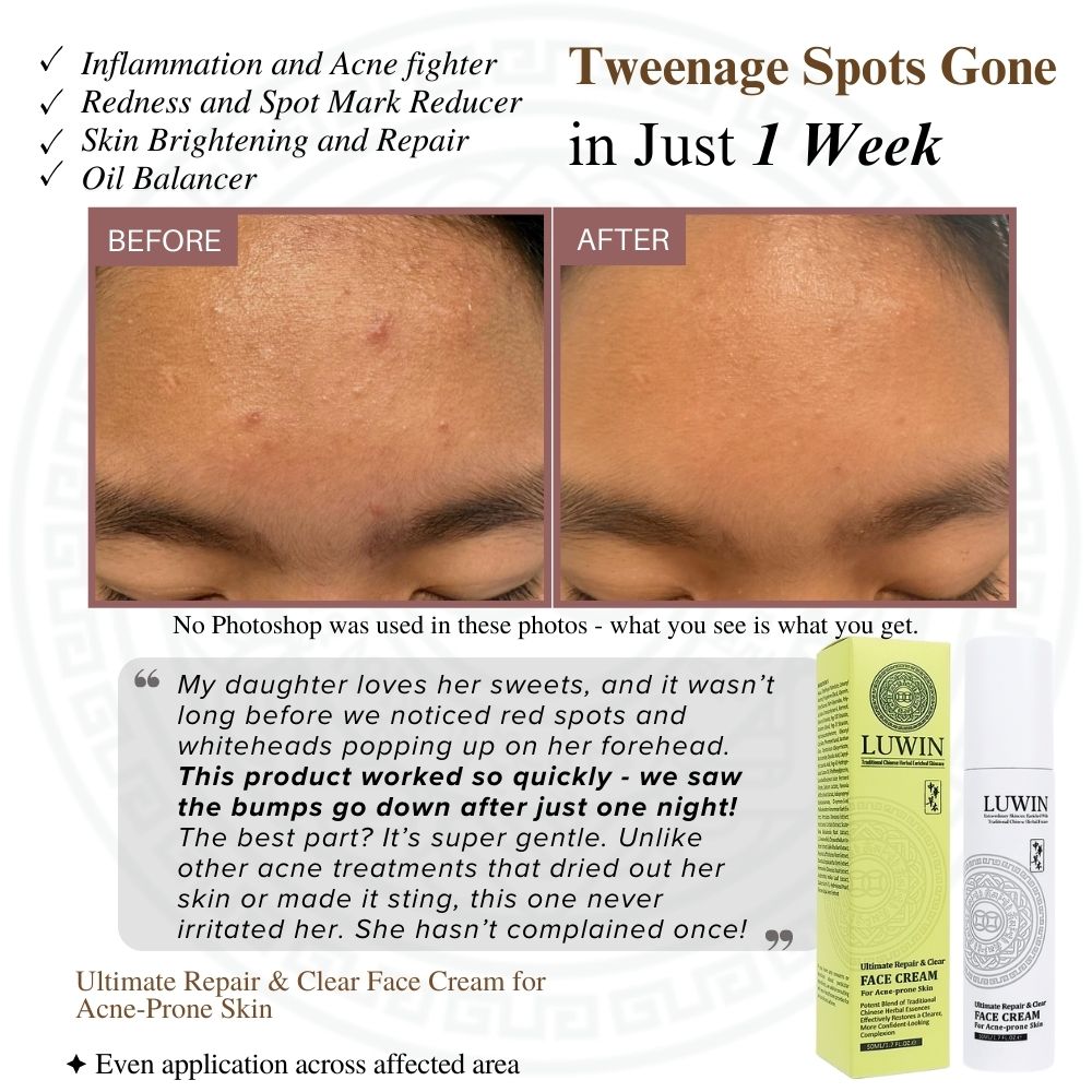 User 3D Before & after with tweenage spots cleared using LUWIN Ultimate Repair & Clear face cream for acne prone skin in one week