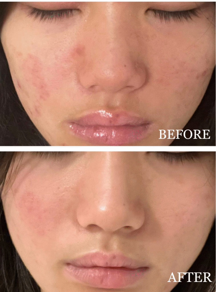 Side-by-side before and after photos showing visible skin improvement on a woman’s face. The "before" image reveals active breakouts and redness on the cheeks and chin, while the "after" image shows significantly clearer, calmer skin with reduced blemishes and smoother texture.
