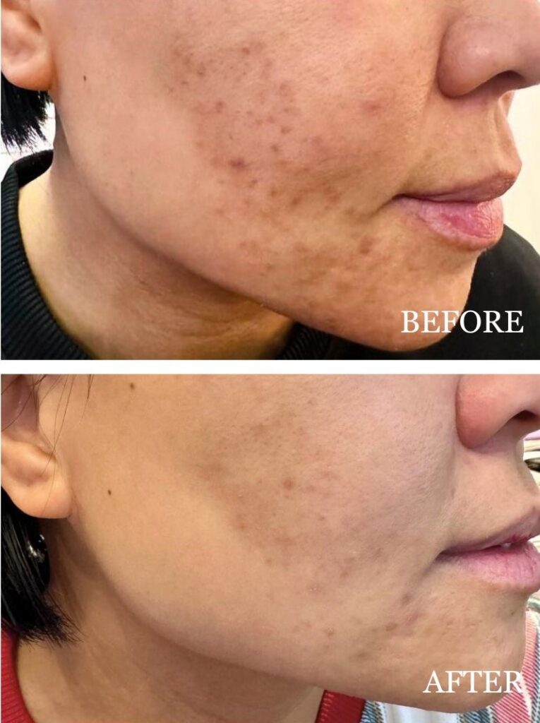 Meet Beth, who faced relentless breakouts due to her busy lifestyle