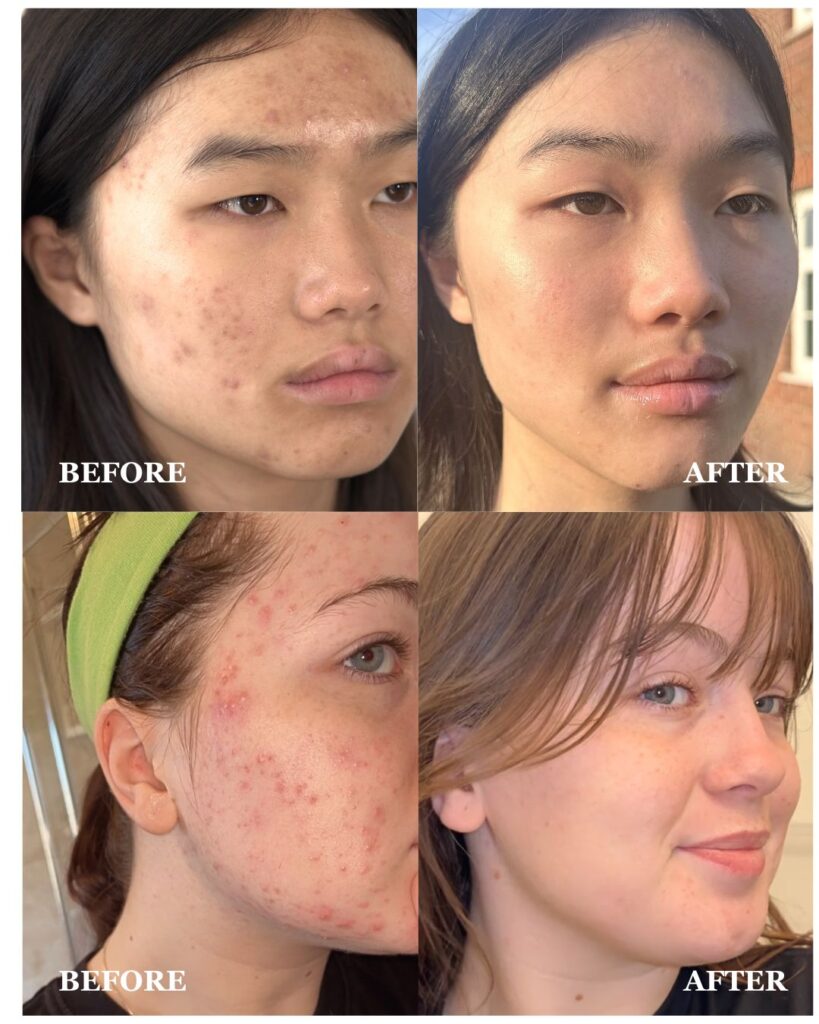 before and after image showing skin transformation