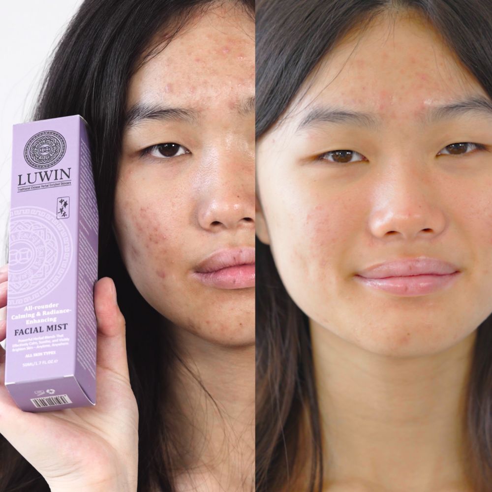 Side-by-side comparison of a young woman's face before and after using LUWIN All-rounder Calming & Radiance-Enhancing Facial Mist. The left side shows acne and redness, while the right side appears clearer and smoother. She holds the LUWIN product box.